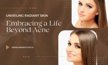 Unveiling Radiant Skin: Embracing a Life Beyond Acne