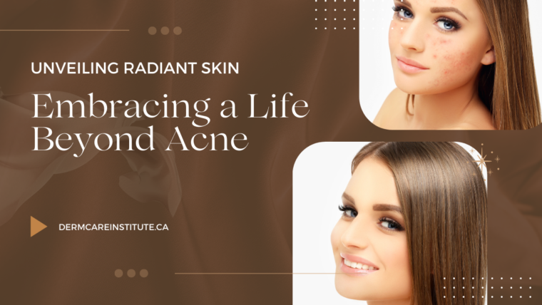 Unveiling Radiant Skin: Embracing a Life Beyond Acne